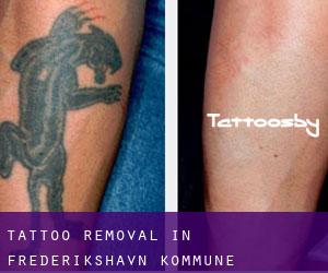 Tattoo Removal in Frederikshavn Kommune