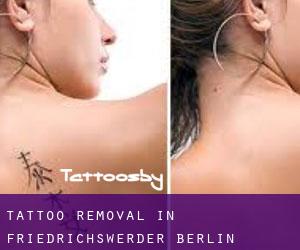 Tattoo Removal in Friedrichswerder (Berlin)