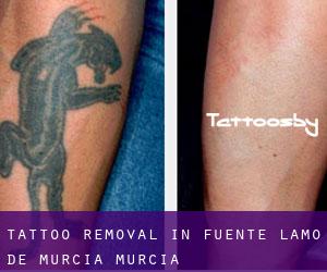 Tattoo Removal in Fuente Álamo de Murcia (Murcia)