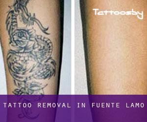 Tattoo Removal in Fuente-Álamo