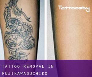 Tattoo Removal in Fujikawaguchiko