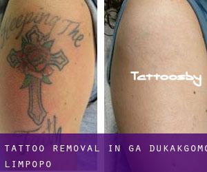 Tattoo Removal in Ga-Dukakgomo (Limpopo)