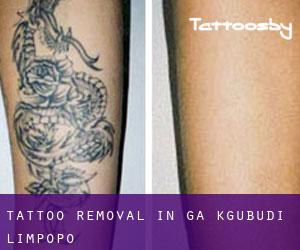 Tattoo Removal in Ga-Kgubudi (Limpopo)
