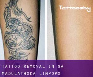 Tattoo Removal in Ga-Madulathoka (Limpopo)