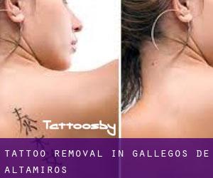 Tattoo Removal in Gallegos de Altamiros