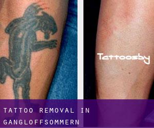Tattoo Removal in Gangloffsömmern