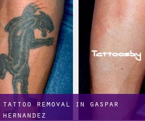 Tattoo Removal in Gaspar Hernández