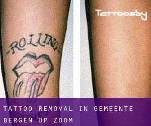 Tattoo Removal in Gemeente Bergen op Zoom