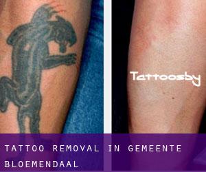Tattoo Removal in Gemeente Bloemendaal