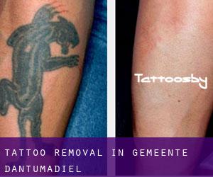Tattoo Removal in Gemeente Dantumadiel