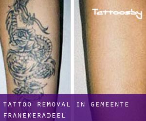 Tattoo Removal in Gemeente Franekeradeel