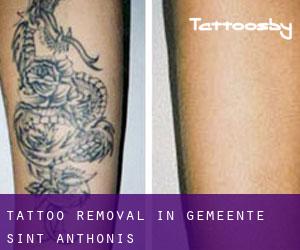 Tattoo Removal in Gemeente Sint Anthonis