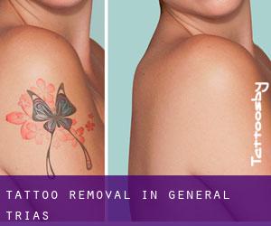 Tattoo Removal in General Trias