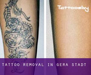 Tattoo Removal in Gera Stadt