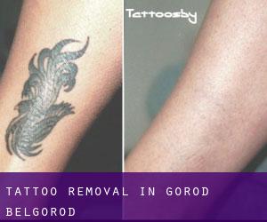 Tattoo Removal in Gorod Belgorod