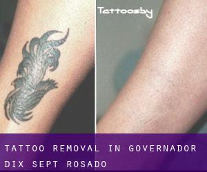 Tattoo Removal in Governador Dix-Sept Rosado