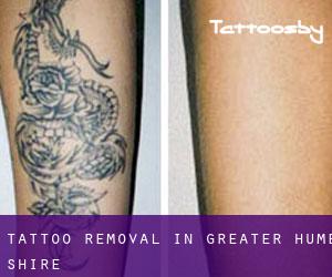 Tattoo Removal in Greater Hume Shire