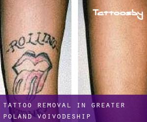 Tattoo Removal in Greater Poland Voivodeship