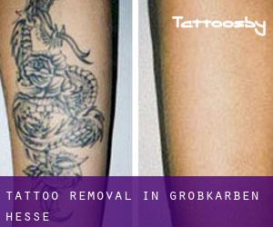 Tattoo Removal in Großkarben (Hesse)