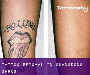 Tattoo Removal in Guangdong Sheng