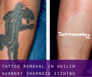 Tattoo Removal in Guilin (Guangxi Zhuangzu Zizhiqu)