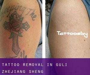 Tattoo Removal in Guli (Zhejiang Sheng)