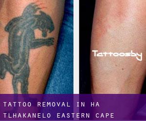 Tattoo Removal in Ha-Tlhakanelo (Eastern Cape)