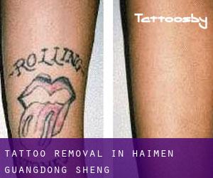 Tattoo Removal in Haimen (Guangdong Sheng)