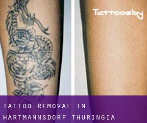 Tattoo Removal in Hartmannsdorf (Thuringia)