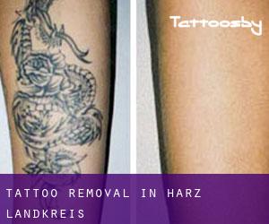 Tattoo Removal in Harz Landkreis
