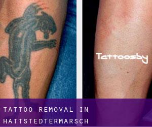 Tattoo Removal in Hattstedtermarsch