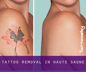 Tattoo Removal in Haute-Saône