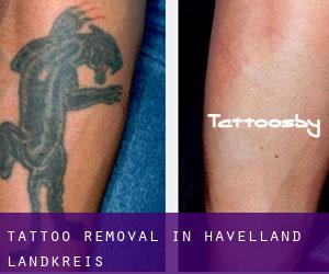 Tattoo Removal in Havelland Landkreis