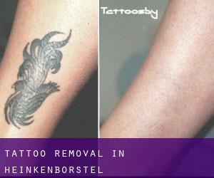 Tattoo Removal in Heinkenborstel
