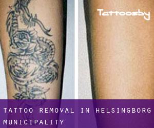 Tattoo Removal in Helsingborg Municipality