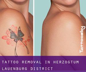 Tattoo Removal in Herzogtum Lauenburg District