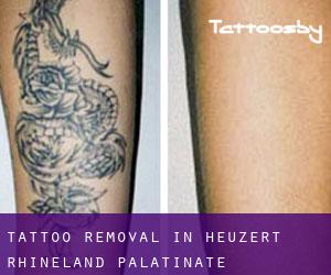 Tattoo Removal in Heuzert (Rhineland-Palatinate)