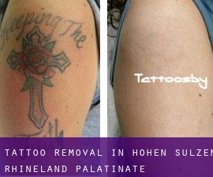 Tattoo Removal in Hohen-Sülzen (Rhineland-Palatinate)