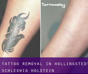 Tattoo Removal in Hollingstedt (Schleswig-Holstein)