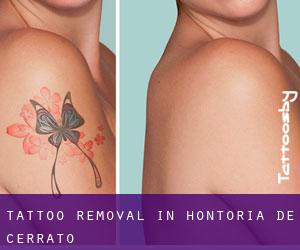 Tattoo Removal in Hontoria de Cerrato