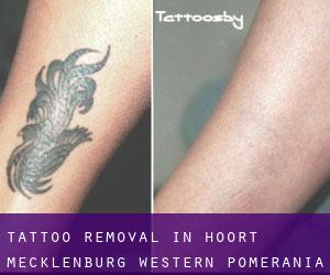 Tattoo Removal in Hoort (Mecklenburg-Western Pomerania)
