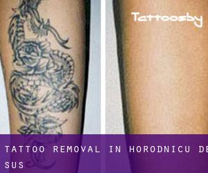 Tattoo Removal in Horodnicu de Sus