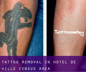 Tattoo Removal in Hôtel-de-Ville (census area)