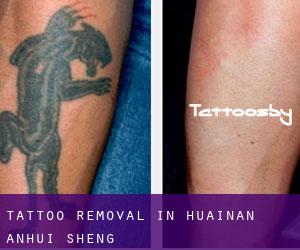 Tattoo Removal in Huainan (Anhui Sheng)