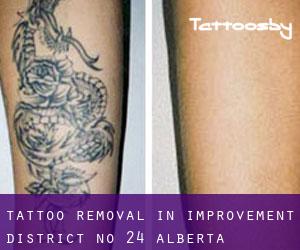Tattoo Removal in Improvement District No. 24 (Alberta)