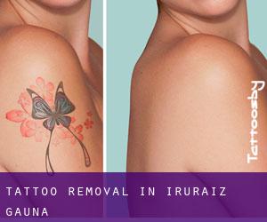 Tattoo Removal in Iruraiz-Gauna