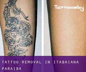 Tattoo Removal in Itabaiana (Paraíba)