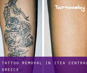Tattoo Removal in Itéa (Central Greece)