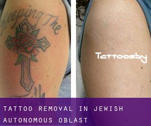 Tattoo Removal in Jewish Autonomous Oblast