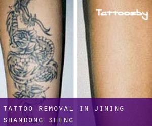 Tattoo Removal in Jining (Shandong Sheng)
